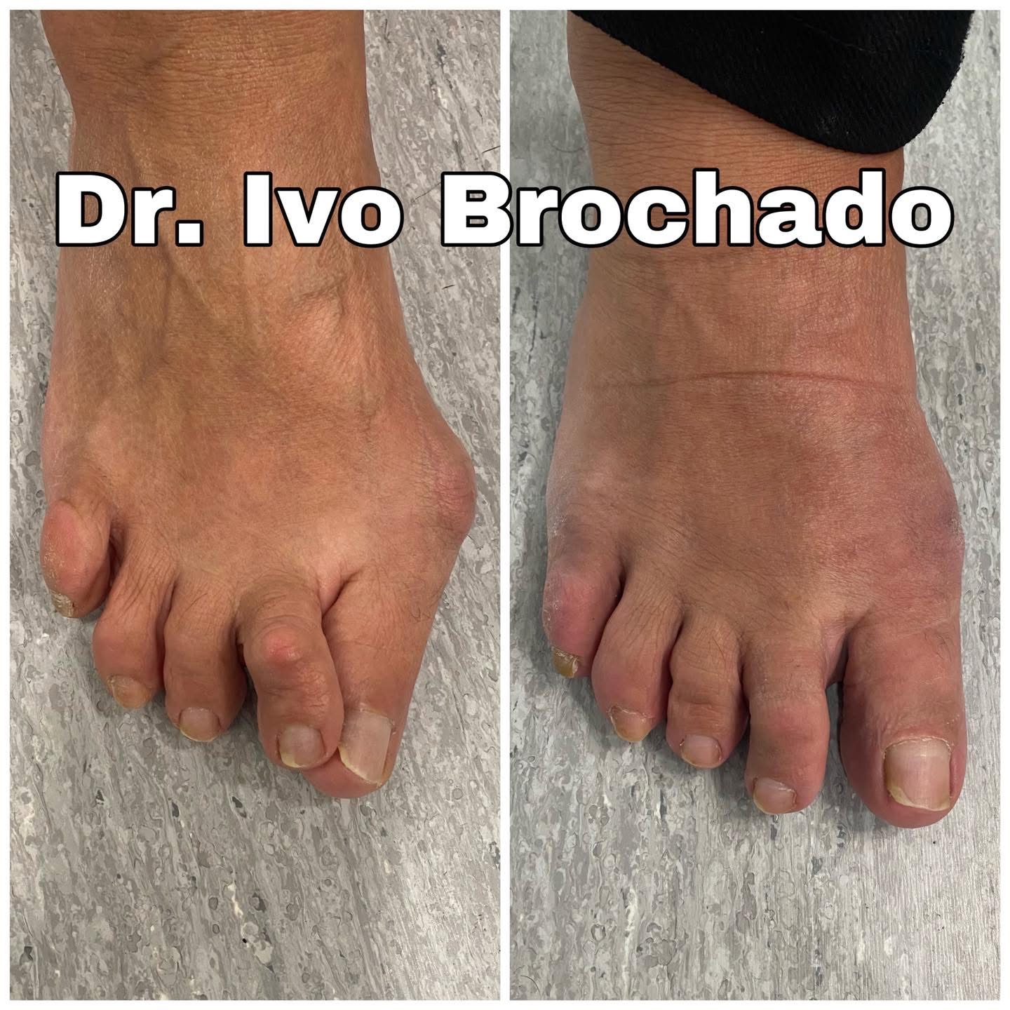 Resultados antes e depois