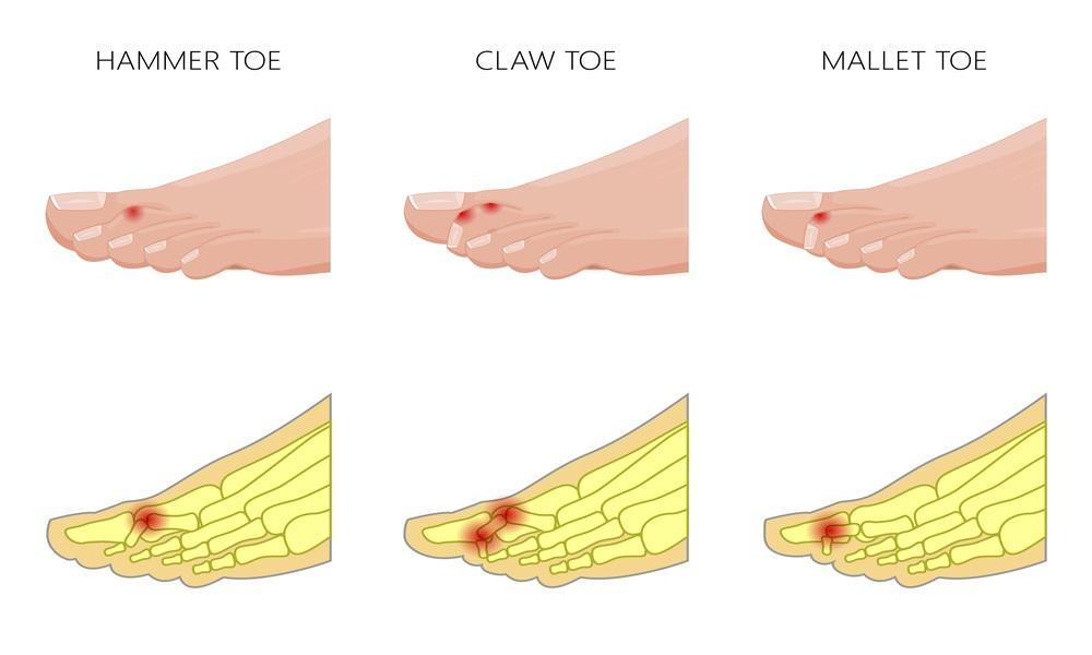 Calosidade por deformidade digital