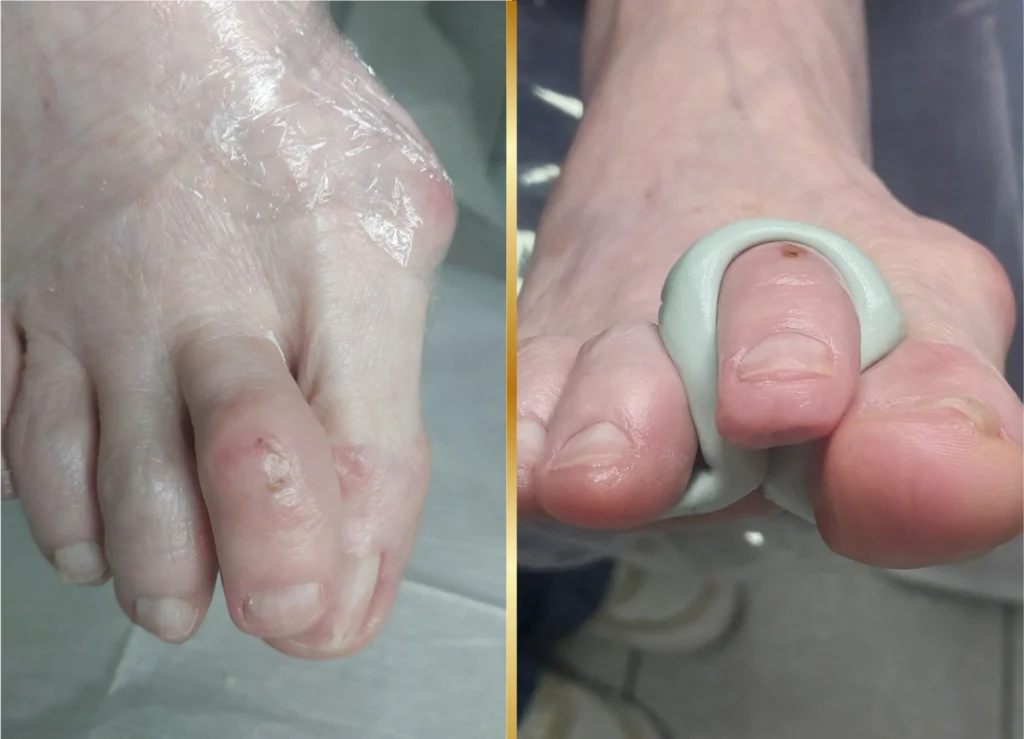 Ortoplastia digital