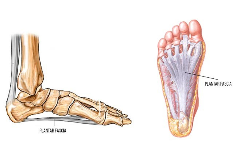 Fascite plantar